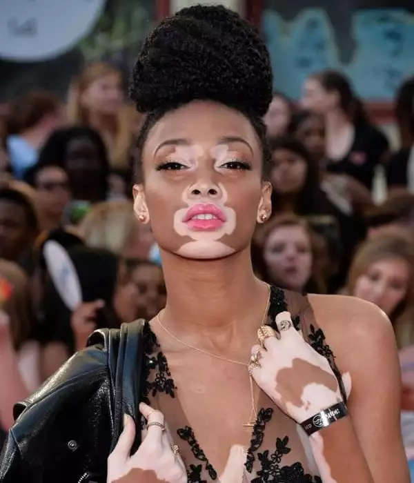 Modele ieșite din comun - Modelul cu vitiligo